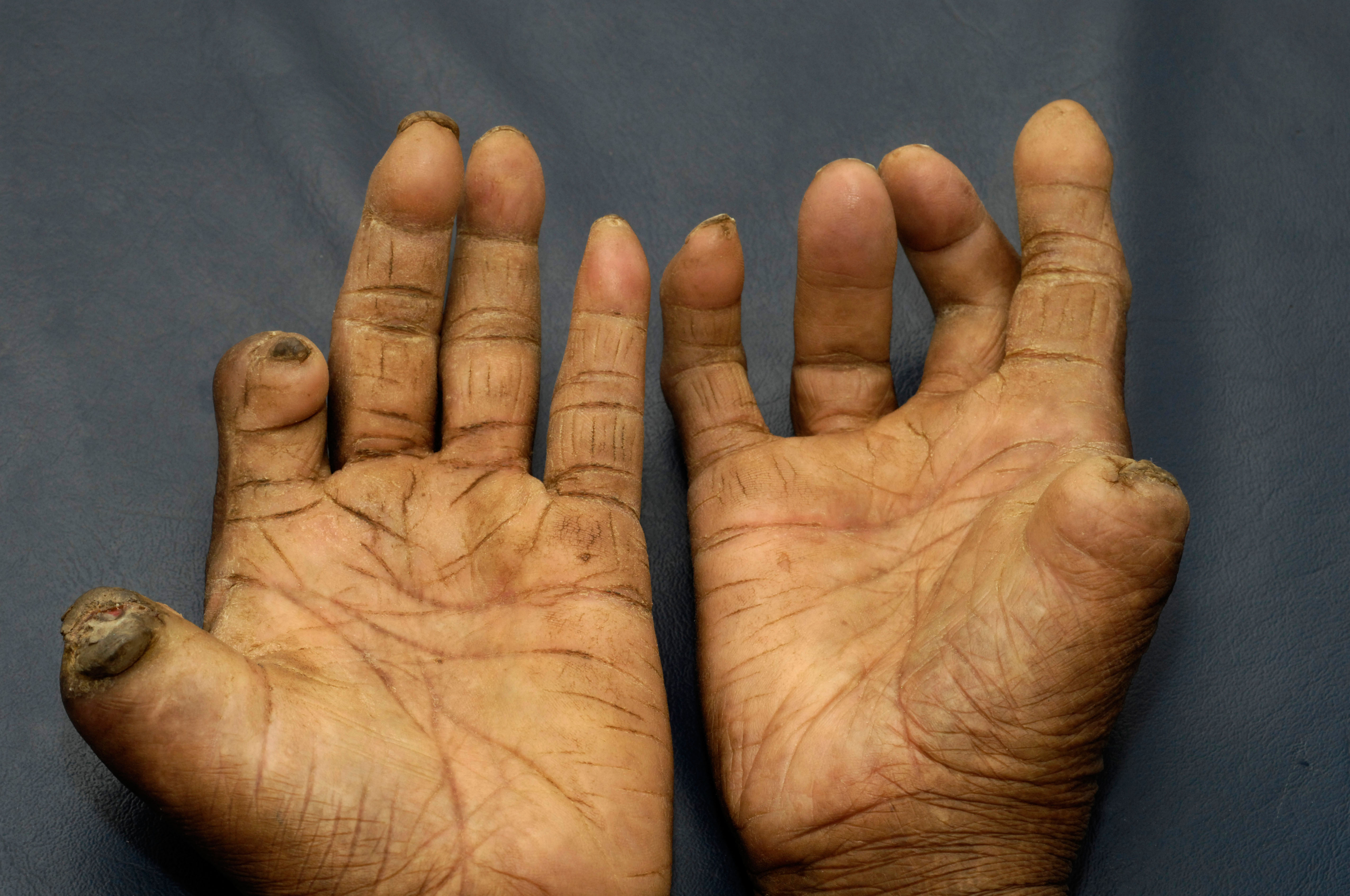 A patient with leprosy.is likely to have had the disease for thirty years or more.