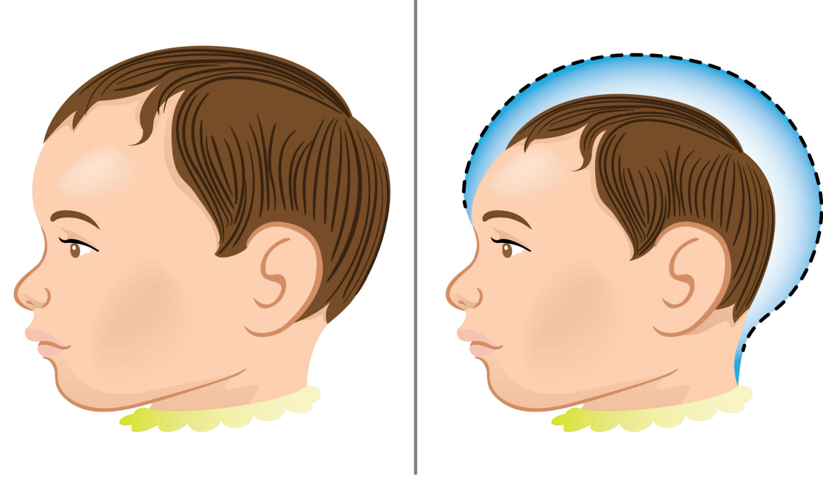 Representation of a healthy child and another one with microcephaly.