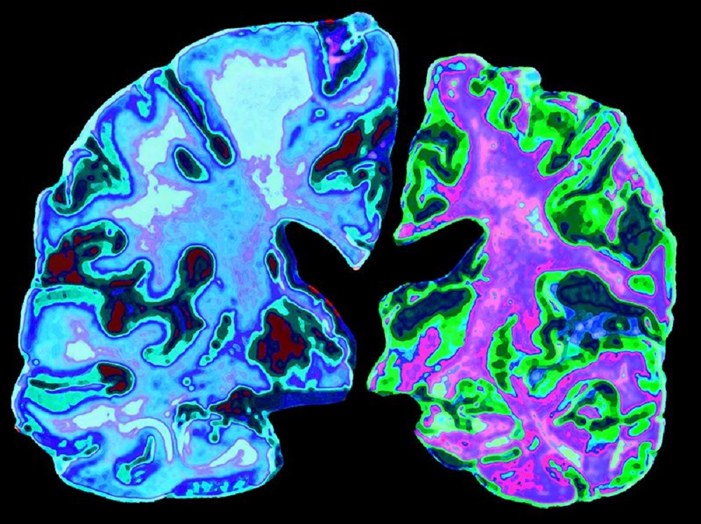 Researchers Demonstrate Lithium Benefits for Elderly People with Alzheimer’s