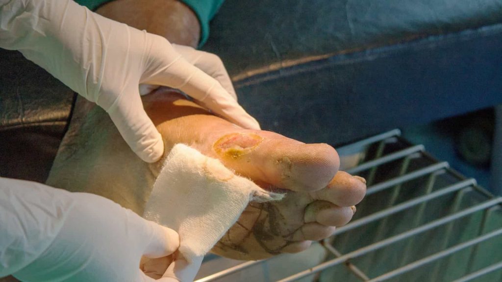This microbe is common in the digestive system, but when it comes into contact with other areas of the body, it devours the skin