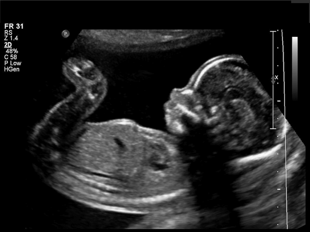 If the woman does not have the right to legal abortion and shows willingness to resort to illegal abortion, the proposal made by the deputy foresees that she will be committed.