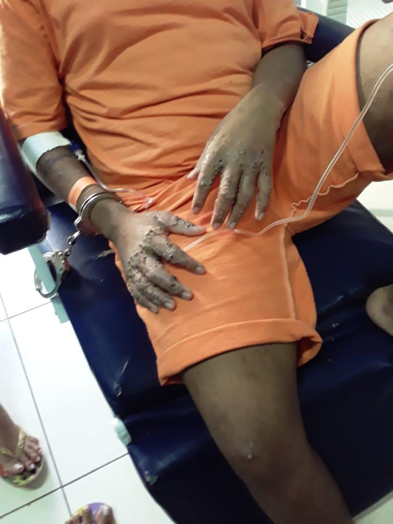 The disease may be caused by the high concentration of scabies, syphilis and geographical worm in prison.