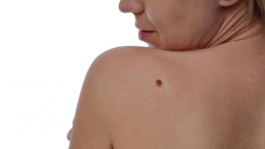 Researchers from the State University of Campinas (Unicamp) improve a software capable of speeding up diagnoses of melanoma type skin cancer. So far, the computer program has achieved 86 percent accuracy in identifying the disease.