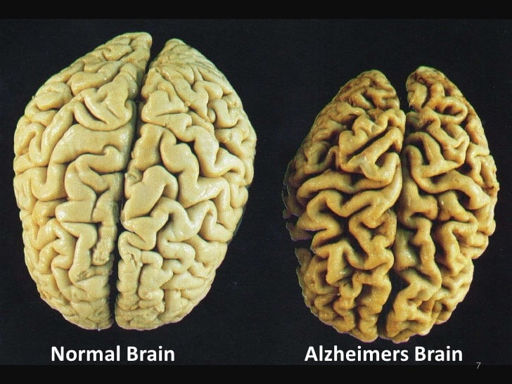 The study, published in the scientific journal Communications Biology, and disclosed by Galileo, shows that significant changes occur in a section of the brain of Alzheimer's patients, more specifically in the cerebellum.