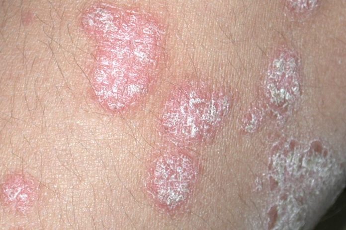 What is the risk to people, particularly children with an autoimmune disease such as psoriasis? Psoriasis is a common skin disease. Chronic and non-contagious, it may be linked to the immune system or have other underlying reasons.