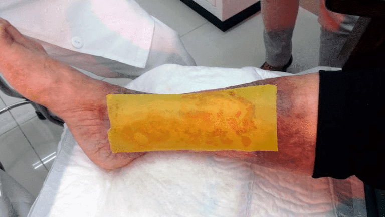 Researchers from the Center for Higher Studies in the city of Tepeaca, Mexico, succeeded in healing the wound of a diabetic foot by applying virgin honey and a patch made of hive wax.