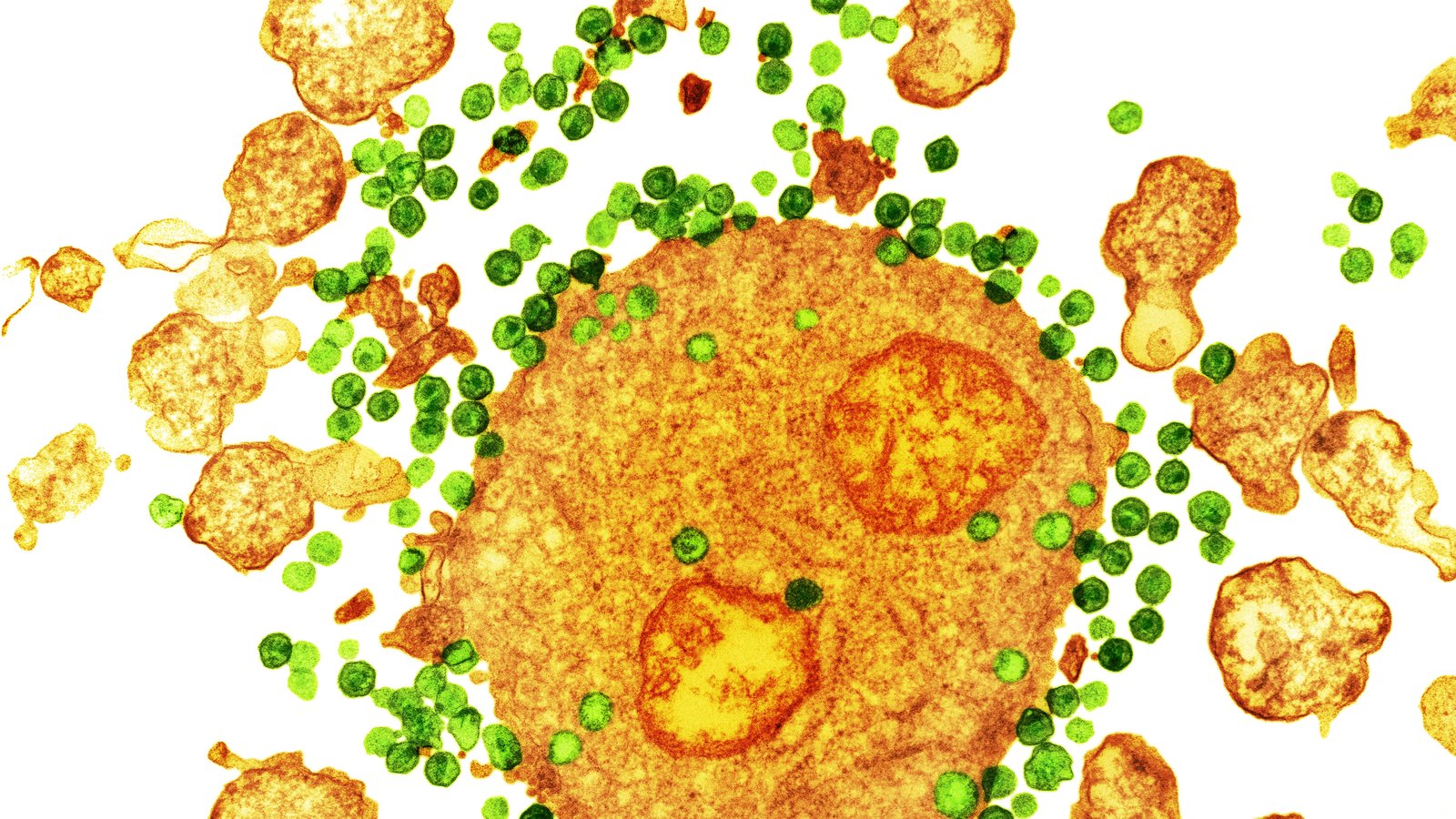 HIV
