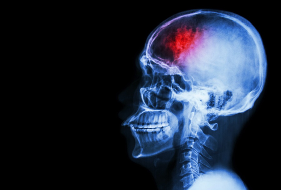 One-third of Covid-19 survivors suffer from neurological or mental disorders – study
