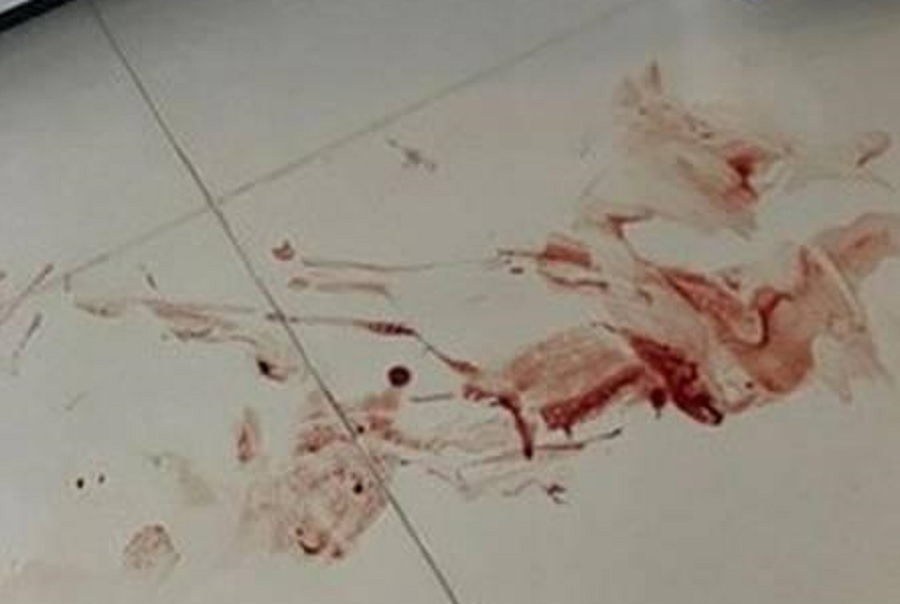 Brazilian federal deputy Hasselmann sustains fractures to face, spine and breaks teeth