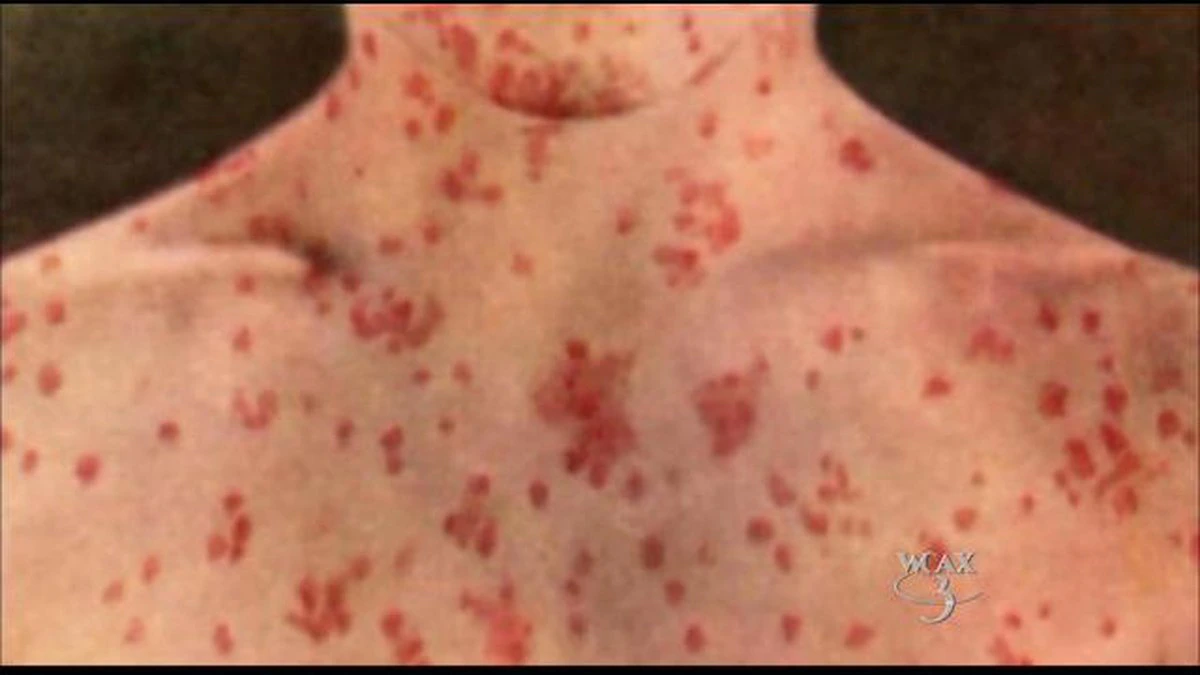 Infectious disease specialist, Tomás Mateo Balmelli explained that the measles virus is much more contagious than the coronavirus