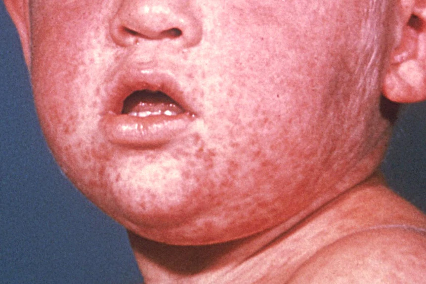 measles5
