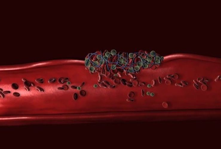 Sepsis