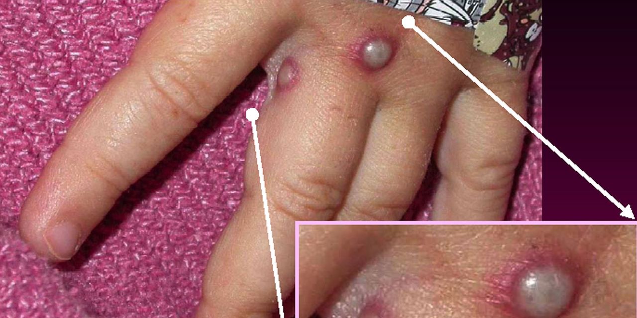 Monkeypox, Monkey pox vaccination craze begins: Biden administration has already ordered millions of vaccine doses