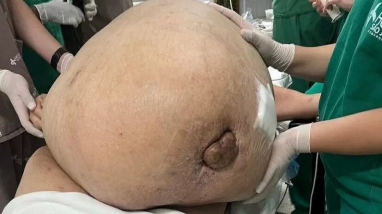 Enormous 46-kilogram tumor removed from woman’s body in Brazil