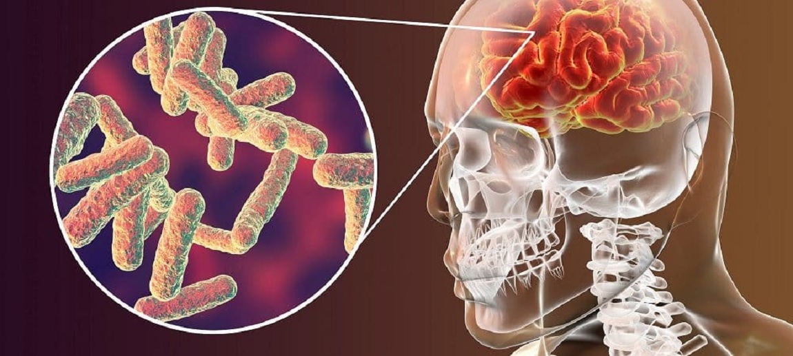 meningite