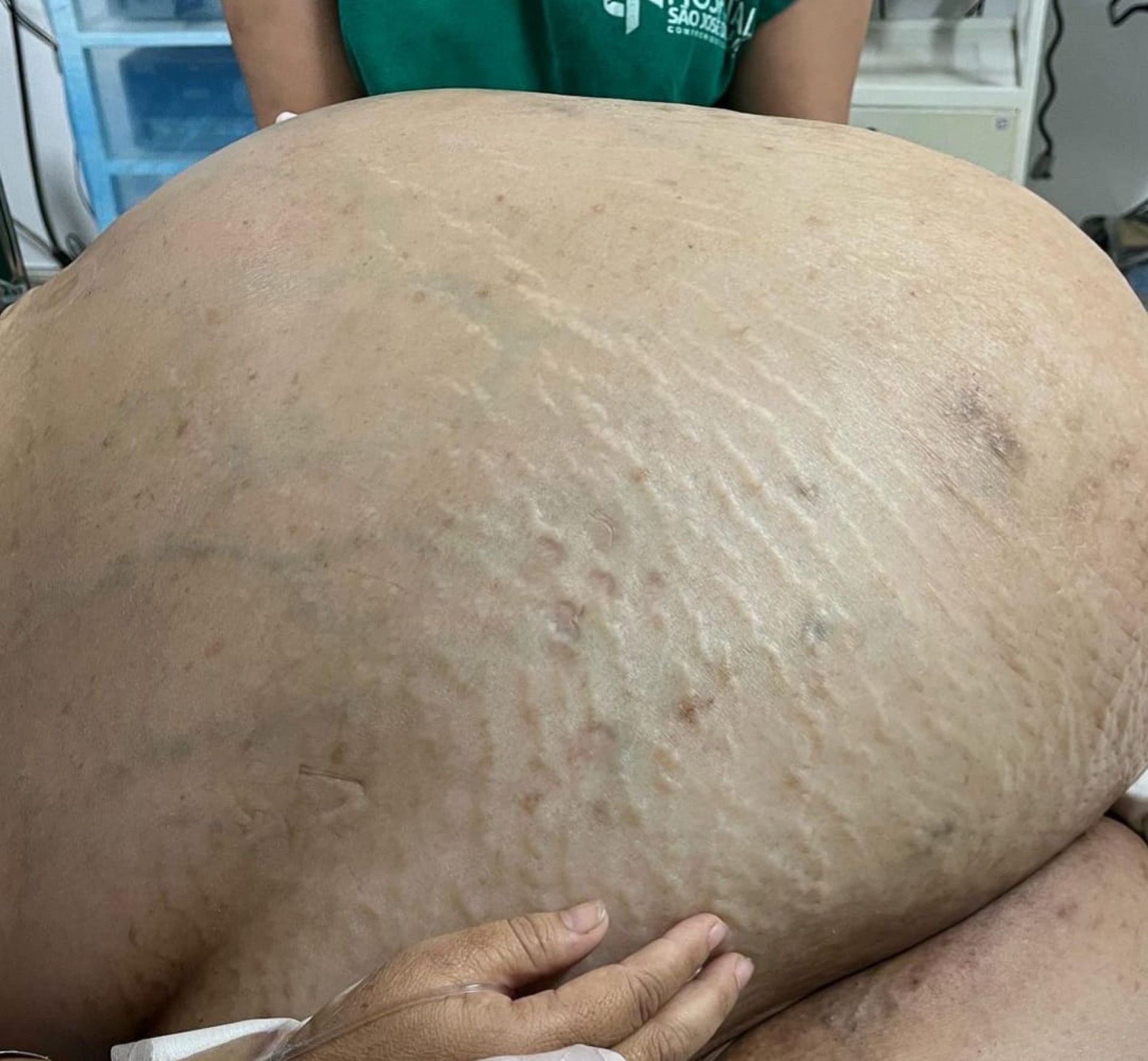 Enormous 46-kilogram tumor removed from woman's body in Brazil. (Photo internet reproduction)