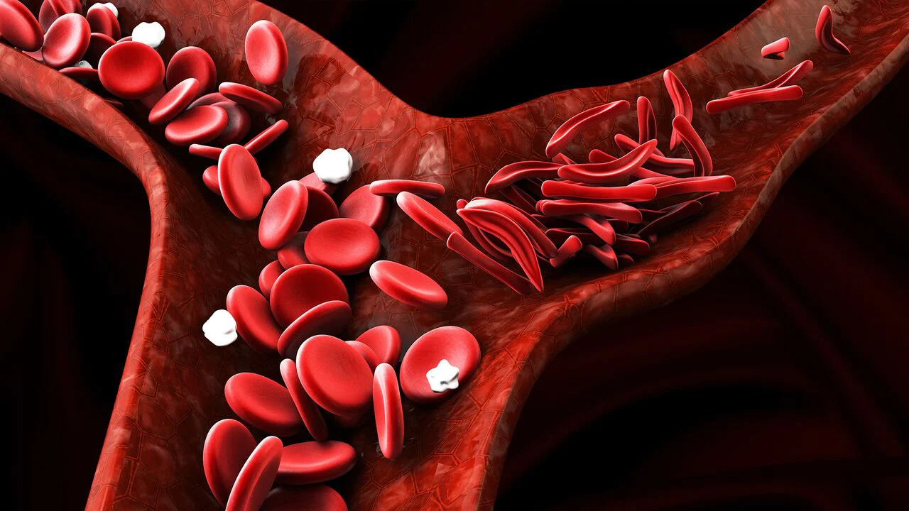sickle-cell-anemia-main-image
