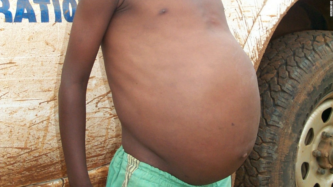 schistosomiasis