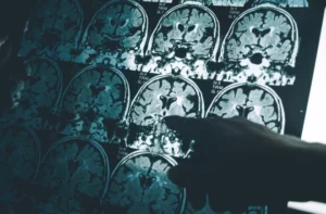 Alzheimer's Study Retraction Sparks Research Integrity Crisis