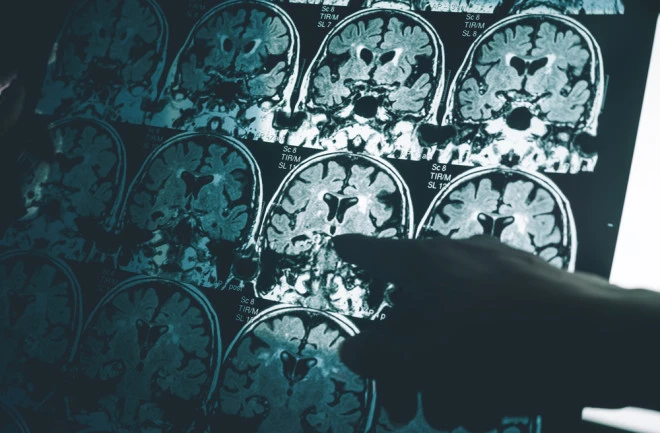 Alzheimer's Study Retraction Sparks Research Integrity Crisis