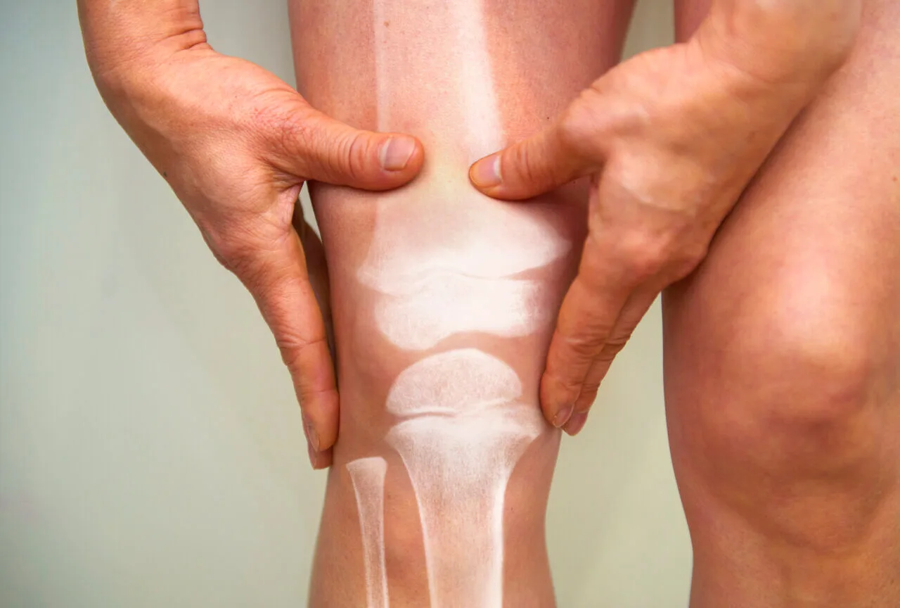 New Hope for Osteoporosis: The CCN3 Connection
