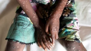 Africa Nears Emergency Declaration Amid Mpox Outbreak