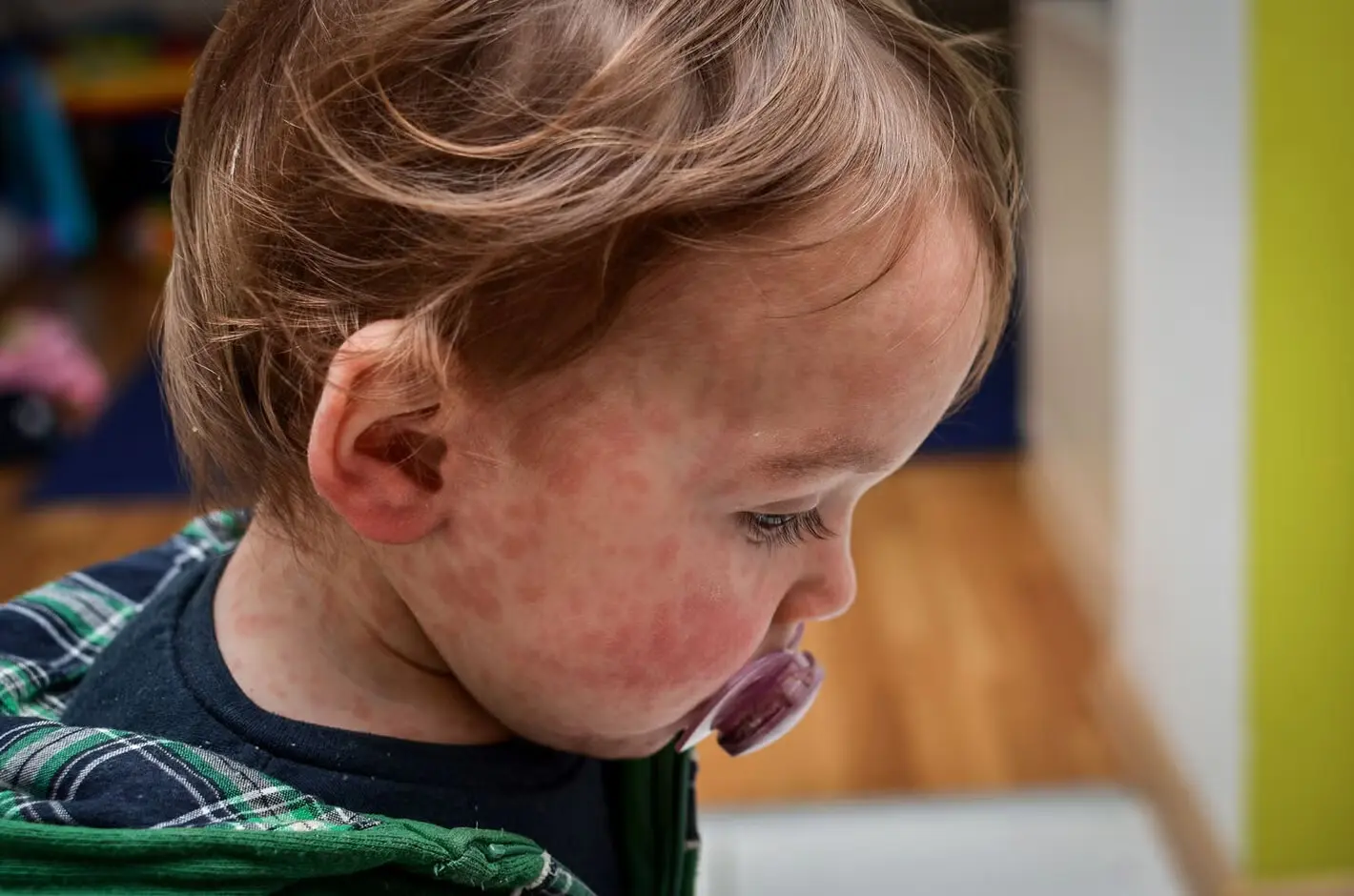 Bolivia Faces Measles Crisis as Vaccination Rates Fall