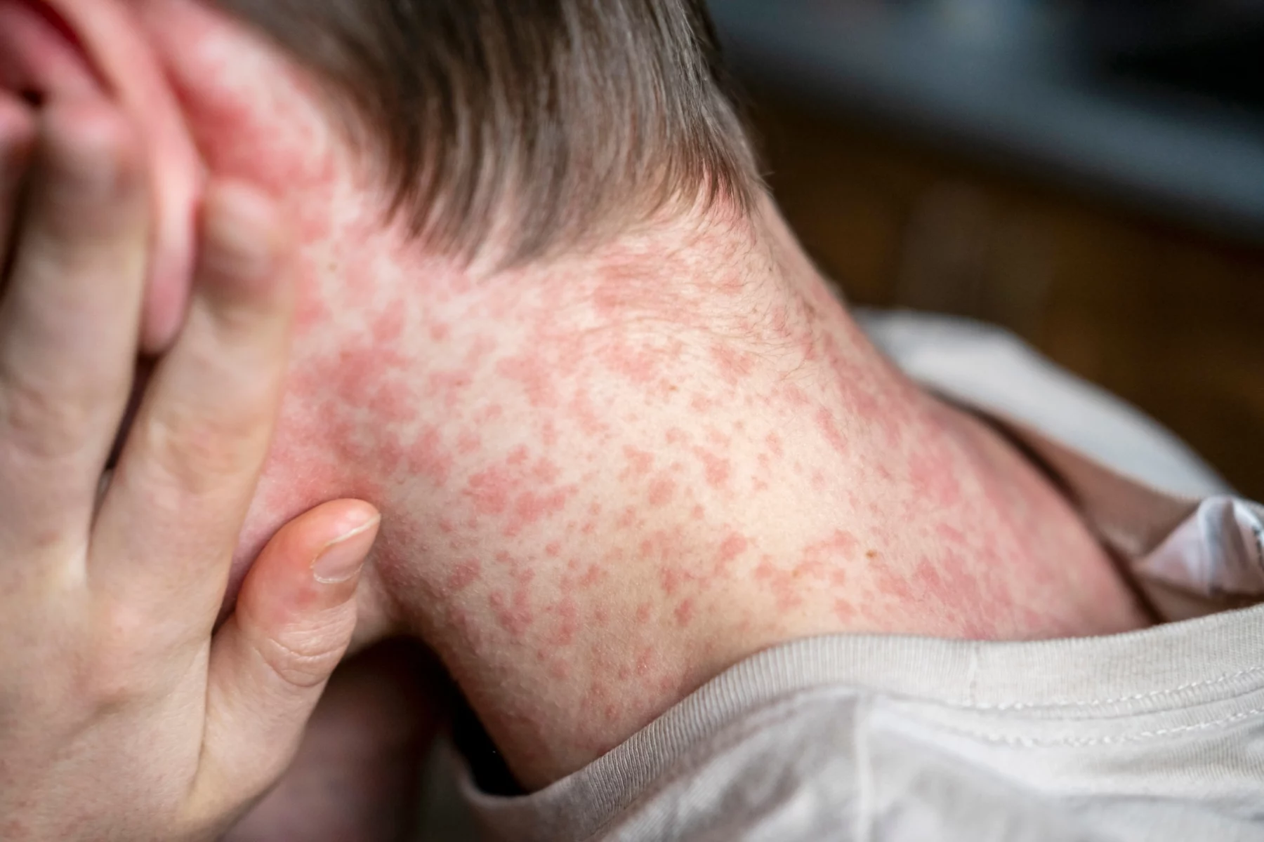 measles-o